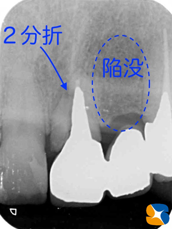 奈良　生駒　最新再生医療インプラント　石切　大阪　静脈麻酔鎮静無料