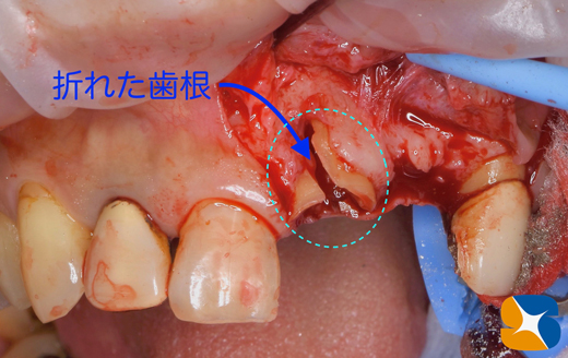 奈良　生駒　最新再生医療インプラント　石切　大阪　静脈麻酔鎮静無料