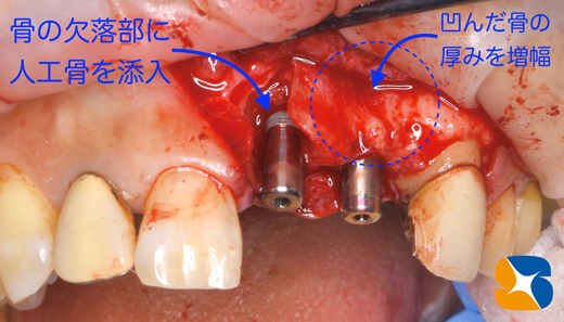 奈良　生駒　最新再生医療インプラント　石切　大阪　静脈麻酔鎮静無料