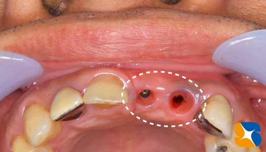 奈良　生駒　最新再生医療インプラント　石切　大阪　静脈麻酔鎮静無料