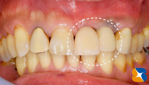 奈良　生駒　最新再生医療インプラント　石切　大阪　静脈麻酔鎮静無料