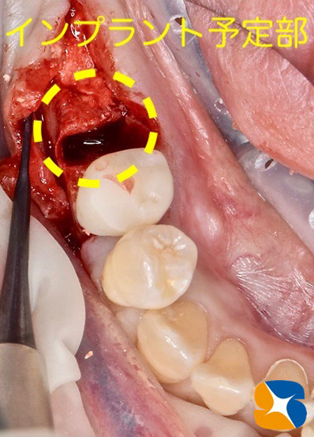 大阪　奈良　生駒　抜歯後の最先端再生医療　インプラント　保険で寝ながら静脈麻酔鎮静　歯科恐怖症