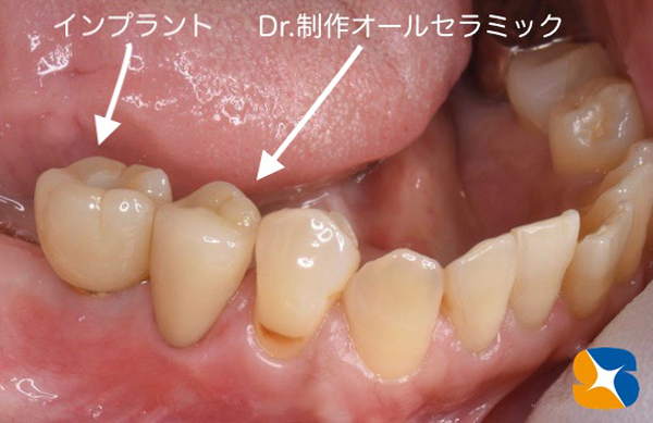 大阪　奈良　生駒　抜歯後の最先端再生医療　インプラント　保険で寝ながら静脈麻酔鎮静　歯科恐怖症