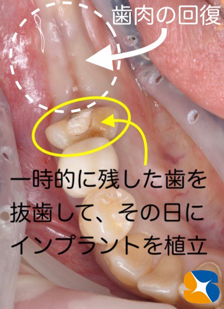 大阪　奈良　生駒　抜歯後の最先端再生医療　インプラント　保険で寝ながら静脈麻酔鎮静　歯科恐怖症