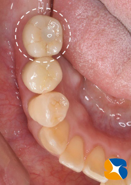 大阪　奈良　生駒　抜歯後の最先端再生医療　インプラント　保険で寝ながら静脈麻酔鎮静　歯科恐怖症