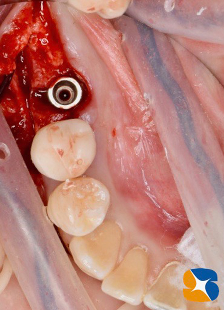 大阪　奈良　生駒　抜歯後の最先端再生医療　インプラント　保険で寝ながら静脈麻酔鎮静　歯科恐怖症