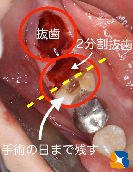 大阪　奈良　生駒　抜歯後の最先端再生医療　インプラント　保険で寝ながら静脈麻酔鎮静　歯科恐怖症