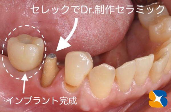 大阪　奈良　生駒　抜歯後の最先端再生医療　インプラント　保険で寝ながら静脈麻酔鎮静　歯科恐怖症