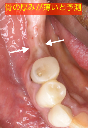 奈良市　生駒市　大和郡山市　東大阪市　インプラント　先進医療の再生医療　骨の再生　怖くない点滴麻酔　静脈麻酔鎮静　手術は１回　短期間