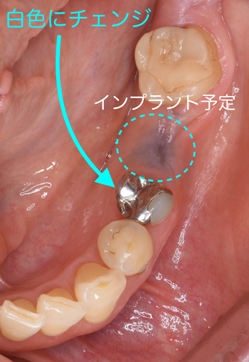 奈良市　生駒市　大和郡山市　東大阪市　インプラント　先進医療の再生医療　骨の再生　怖くない点滴麻酔　静脈麻酔鎮静　手術は１回　短期間