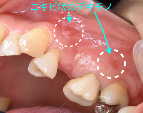大阪の歯医者　良心価格　奈良市　生駒市　大和郡山市　東大阪市　インプラント　先進医療の再生治療　骨の再生　怖くない点滴麻酔　静脈麻酔鎮静　手術は１回　短期間　