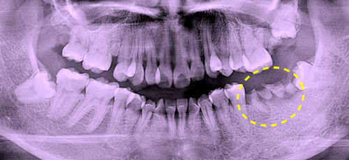 大阪の歯医者　良心価格　奈良市　生駒市　大和郡山市　東大阪市　インプラント　先進医療の再生治療　骨の再生　怖くない点滴麻酔　静脈麻酔鎮静　手術は１回　短期間