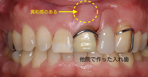 奈良市　生駒市　大和郡山市　東大阪市　インプラント　先進医療の再生医療　骨の再生　怖くない点滴麻酔　静脈麻酔鎮静　手術は１回　短期間