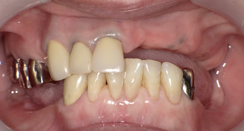 奈良市　生駒市　大和郡山市　東大阪市　インプラント　先進医療の再生医療　骨の再生　怖くない点滴麻酔　静脈麻酔鎮静　手術は１回　短期間