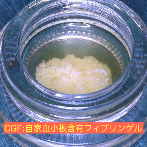 大阪の歯医者　良心価格　奈良市　生駒市　大和郡山市　東大阪市　インプラント　先進医療の再生治療　骨の再生　怖くない点滴麻酔　静脈麻酔鎮静　手術は１回　短期間