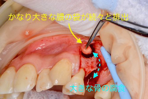 大阪の歯医者　良心価格　奈良市　生駒市　大和郡山市　東大阪市　インプラント　先進医療の再生治療　骨の再生　怖くない点滴麻酔　静脈麻酔鎮静　手術は１回　短期間