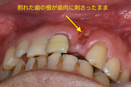 奈良市　生駒市　大和郡山市　東大阪市　インプラント　先進医療の再生医療　骨の再生　怖くない点滴麻酔　静脈麻酔鎮静　手術は１回　短期間
