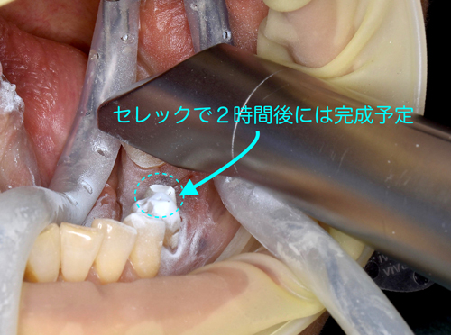 奈良市　生駒市　大和郡山市　東大阪市　インプラント　先進医療の再生医療　骨の再生　怖くない点滴麻酔　静脈麻酔鎮静　手術は１回　短期間