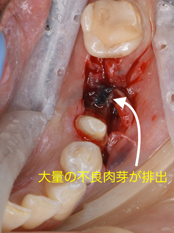 奈良市　生駒市　大和郡山市　東大阪市　インプラント　先進医療の再生医療　骨の再生　怖くない点滴麻酔　静脈麻酔鎮静　手術は１回　短期間