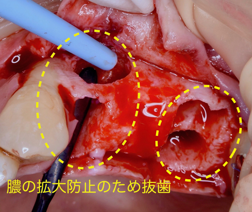 大阪の歯医者　良心価格　奈良市　生駒市　大和郡山市　東大阪市　インプラント　先進医療の再生治療　骨の再生　怖くない点滴麻酔　静脈麻酔鎮静　手術は１回　短期間