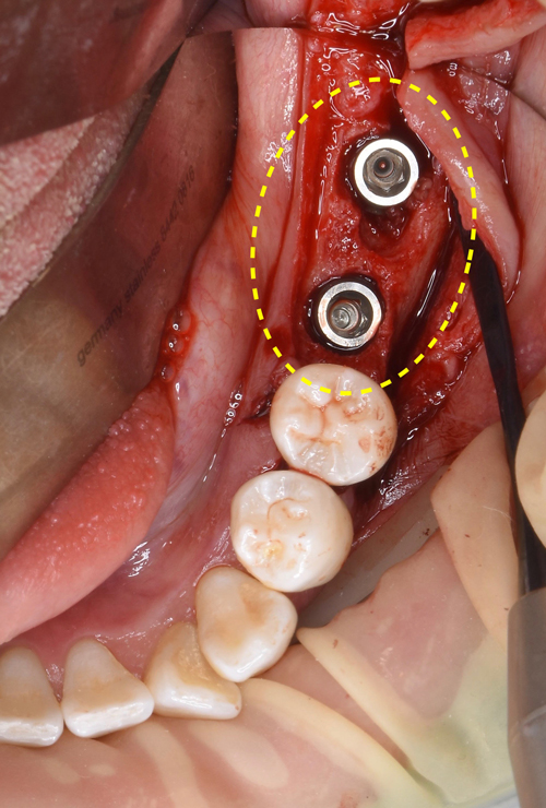 大阪の歯医者　良心価格　奈良市　生駒市　大和郡山市　東大阪市　インプラント　先進医療の再生治療　骨の再生　怖くない点滴麻酔　静脈麻酔鎮静　手術は１回　短期間