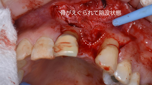 奈良市　生駒市　大和郡山市　東大阪市　インプラント　先進医療の再生医療　骨の再生　怖くない点滴麻酔　静脈麻酔鎮静　手術は１回　短期間