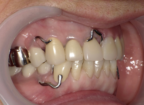 奈良市　生駒市　大和郡山市　東大阪市　インプラント　先進医療の再生医療　骨の再生　怖くない点滴麻酔　静脈麻酔鎮静　手術は１回　短期間