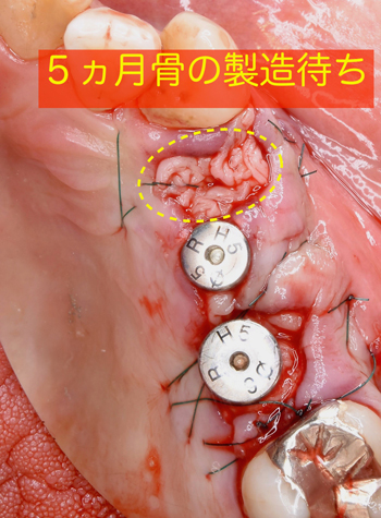 大阪の歯医者　良心価格　奈良市　生駒市　大和郡山市　東大阪市　インプラント　先進医療の再生治療　骨の再生　怖くない点滴麻酔　静脈麻酔鎮静　手術は１回　短期間