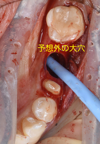 奈良市　生駒市　大和郡山市　東大阪市　インプラント　先進医療の再生医療　骨の再生　怖くない点滴麻酔　静脈麻酔鎮静　手術は１回　短期間