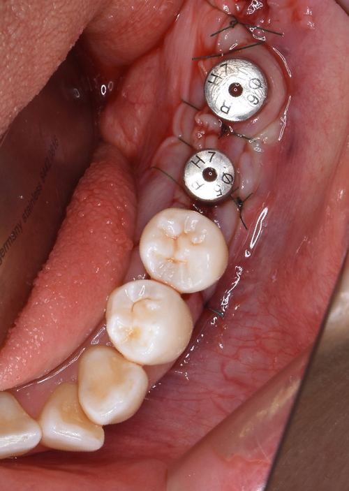 大阪の歯医者　良心価格　奈良市　生駒市　大和郡山市　東大阪市　インプラント　先進医療の再生治療　骨の再生　怖くない点滴麻酔　静脈麻酔鎮静　手術は１回　短期間