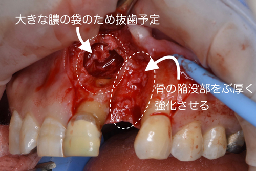 奈良市　生駒市　大和郡山市　東大阪市　インプラント　先進医療の再生医療　骨の再生　怖くない点滴麻酔　静脈麻酔鎮静　手術は１回　短期間
