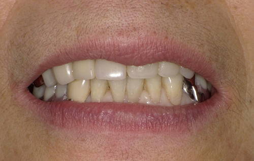 奈良市　生駒市　大和郡山市　東大阪市　インプラント　先進医療の再生医療　骨の再生　怖くない点滴麻酔　静脈麻酔鎮静　手術は１回　短期間