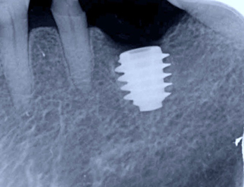 奈良市　生駒市　大和郡山市　東大阪市　インプラント　先進医療の再生医療　骨の再生　怖くない点滴麻酔　静脈麻酔鎮静　手術は１回　短期間