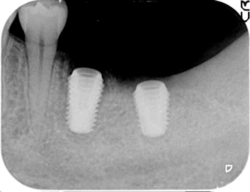 大阪の歯医者　良心価格　奈良市　生駒市　大和郡山市　東大阪市　インプラント　先進医療の再生治療　骨の再生　怖くない点滴麻酔　静脈麻酔鎮静　手術は１回　短期間