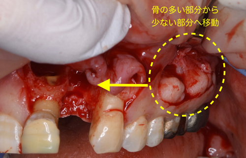 奈良市　生駒市　大和郡山市　東大阪市　インプラント　先進医療の再生医療　骨の再生　怖くない点滴麻酔　静脈麻酔鎮静　手術は１回　短期間