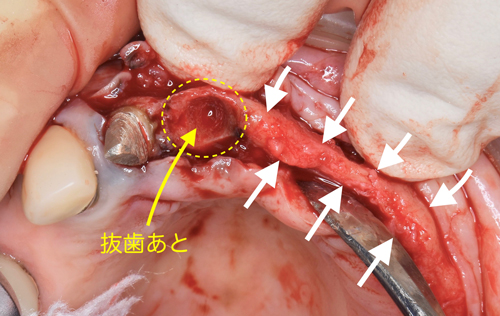 奈良市　生駒市　大和郡山市　東大阪市　インプラント　先進医療の再生医療　骨の再生　怖くない点滴麻酔　静脈麻酔鎮静　手術は１回　短期間