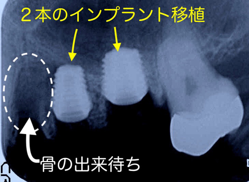 大阪の歯医者　良心価格　奈良市　生駒市　大和郡山市　東大阪市　インプラント　先進医療の再生治療　骨の再生　怖くない点滴麻酔　静脈麻酔鎮静　手術は１回　短期間