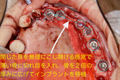 奈良市　生駒市　大和郡山市　東大阪市　インプラント　先進医療の再生医療　骨の再生　怖くない点滴麻酔　静脈麻酔鎮静　手術は１回　短期間