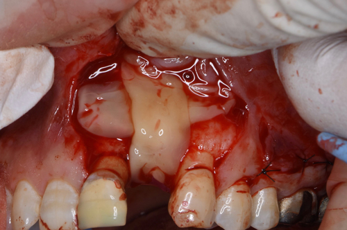 奈良市　生駒市　大和郡山市　東大阪市　インプラント　先進医療の再生医療　骨の再生　怖くない点滴麻酔　静脈麻酔鎮静　手術は１回　短期間
