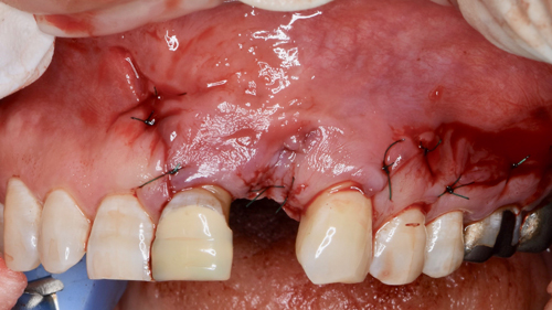 奈良市　生駒市　大和郡山市　東大阪市　インプラント　先進医療の再生医療　骨の再生　怖くない点滴麻酔　静脈麻酔鎮静　手術は１回　短期間