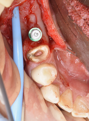 奈良市　生駒市　大和郡山市　東大阪市　インプラント　先進医療の再生医療　骨の再生　怖くない点滴麻酔　静脈麻酔鎮静　手術は１回　短期間