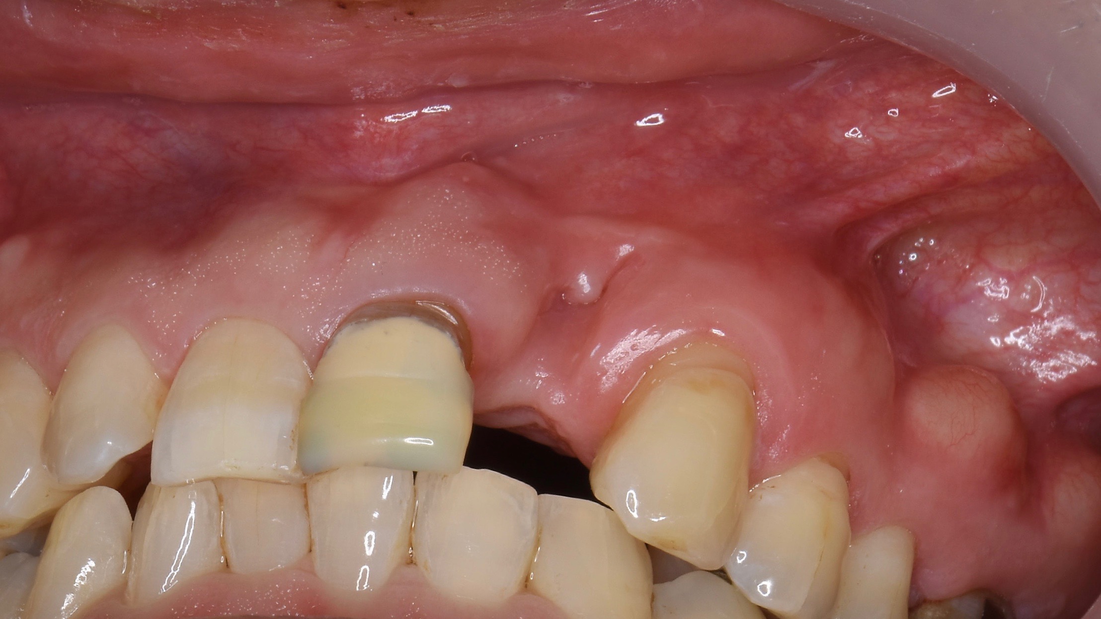 奈良市　生駒市　大和郡山市　東大阪市　インプラント　先進医療の再生医療　骨の再生　怖くない点滴麻酔　静脈麻酔鎮静　手術は１回　短期間