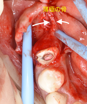 奈良市　生駒市　大和郡山市　東大阪市　インプラント　先進医療の再生医療　骨の再生　怖くない点滴麻酔　静脈麻酔鎮静　手術は１回　短期間