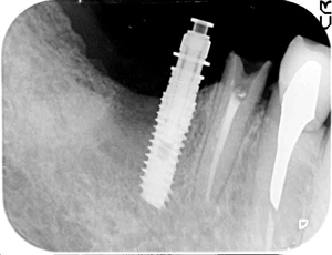 奈良市　生駒市　大和郡山市　東大阪市　インプラント　先進医療の再生医療　骨の再生　怖くない点滴麻酔　静脈麻酔鎮静　手術は１回　短期間