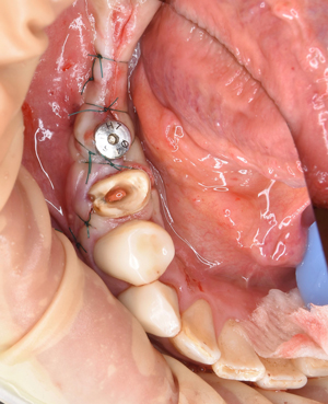 奈良市　生駒市　大和郡山市　東大阪市　インプラント　先進医療の再生医療　骨の再生　怖くない点滴麻酔　静脈麻酔鎮静　手術は１回　短期間