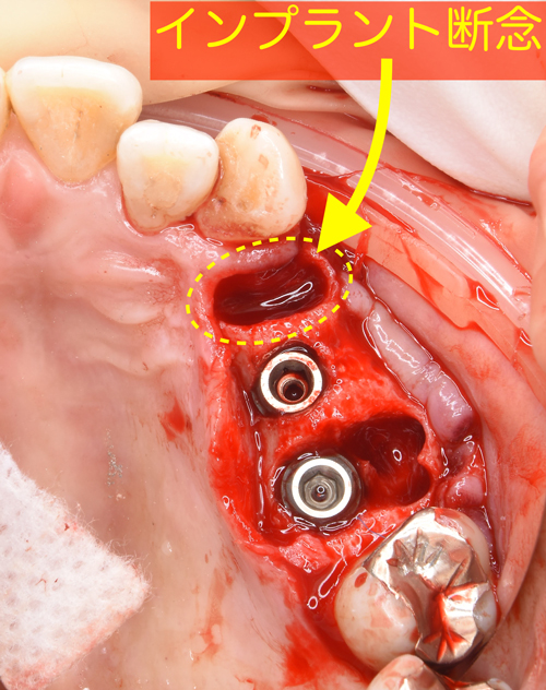 大阪の歯医者　良心価格　奈良市　生駒市　大和郡山市　東大阪市　インプラント　先進医療の再生治療　骨の再生　怖くない点滴麻酔　静脈麻酔鎮静　手術は１回　短期間