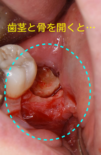 石切　東大阪　親知らず　寝ながら　怖くない　痛くない　張れない　究極の抜歯　保険適用