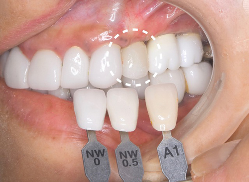 インプラントを受けられる方は寝ながら点滴麻酔鎮静は無料　東大阪　奈良市　生駒市　骨の先端再生治療