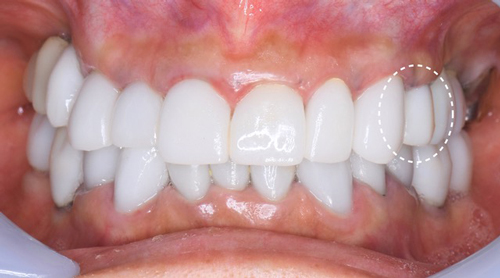 インプラントを受けられる方は寝ながら点滴麻酔鎮静は無料　東大阪　奈良市　生駒市　骨の先端再生治療