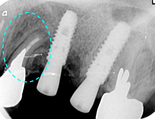 インプラントを受けられる方は寝ながら点滴麻酔鎮静は無料　東大阪　奈良市　生駒市　骨の先端再生治療